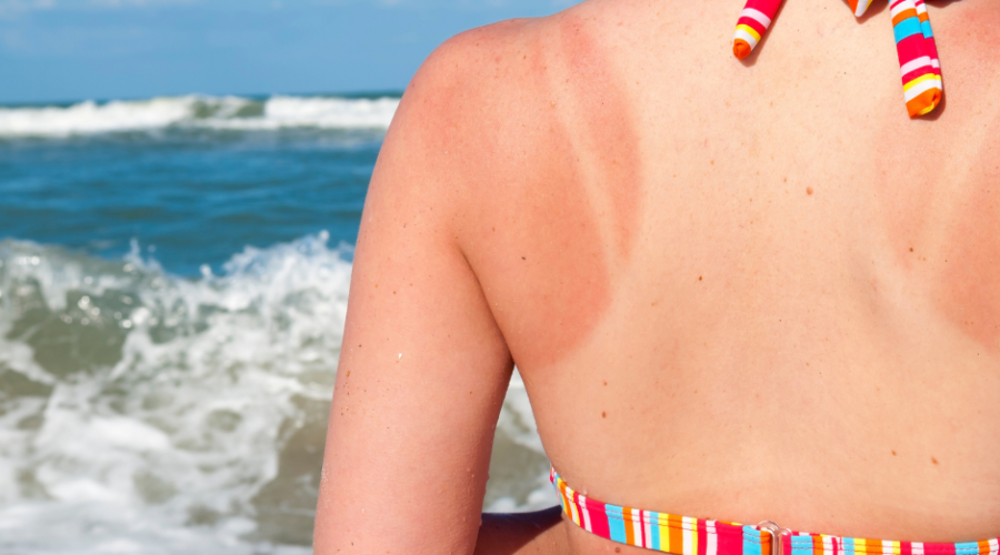 Why a Humidifier will Help Your Sunburned Skin | Port Aransas Explorer